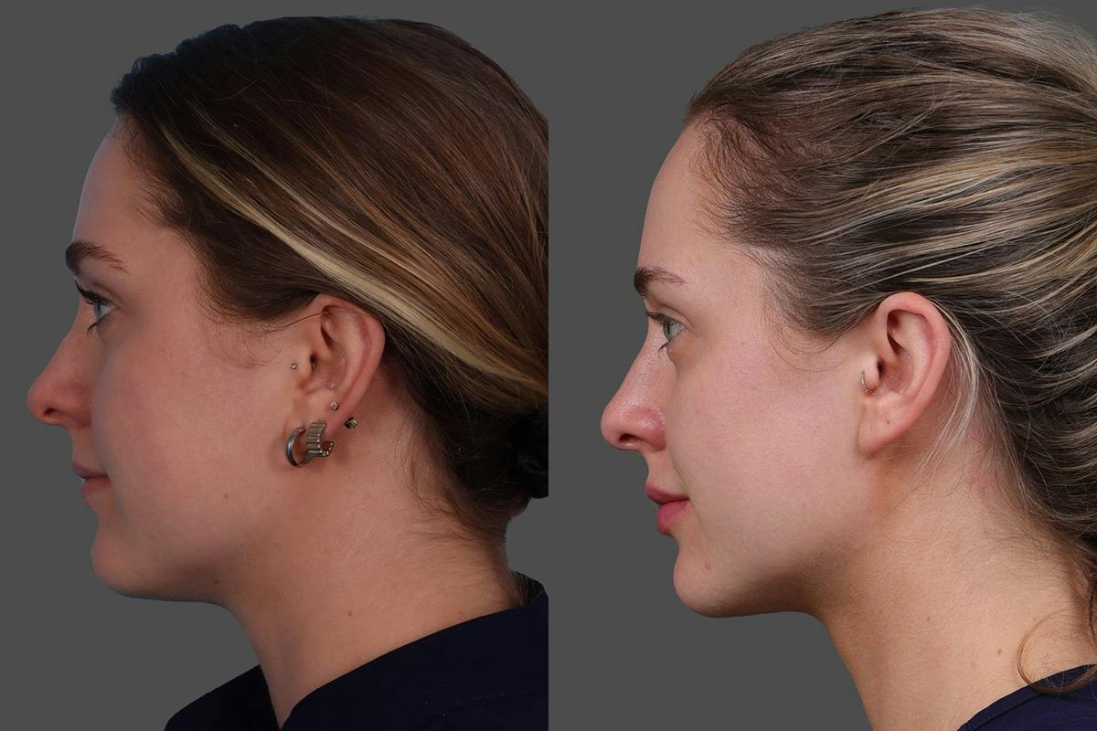 Moxi® Before & After Gallery - Patient 201789 - Image 5