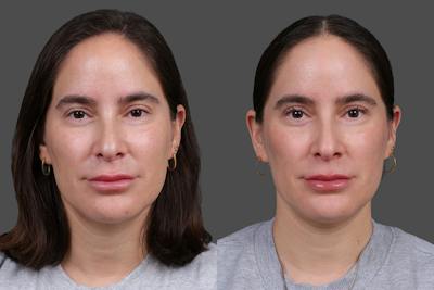 CO2 Fractional Laser Before & After Gallery - Patient 661355 - Image 1