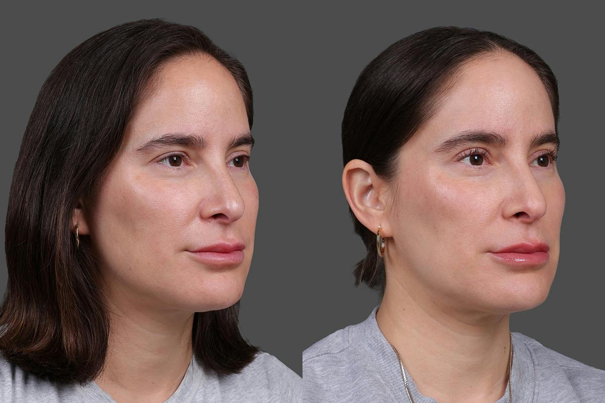 CO2 Fractional Laser Before & After Gallery - Patient 661355 - Image 2