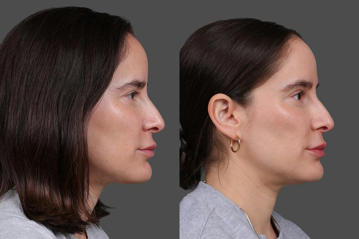 CO2 Fractional Laser Before & After Gallery - Patient 661355 - Image 3