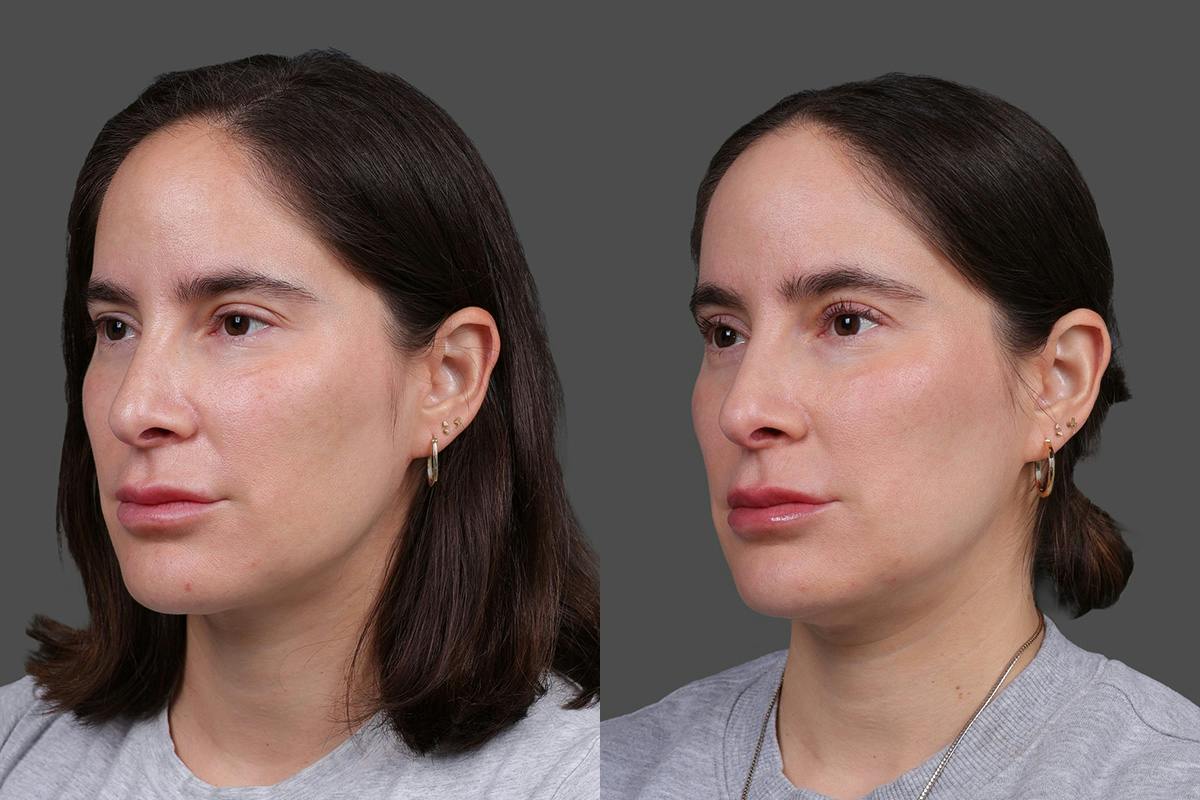 CO2 Fractional Laser Before & After Gallery - Patient 661355 - Image 4