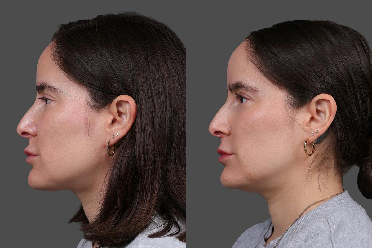 CO2 Fractional Laser Before & After Gallery - Patient 661355 - Image 5