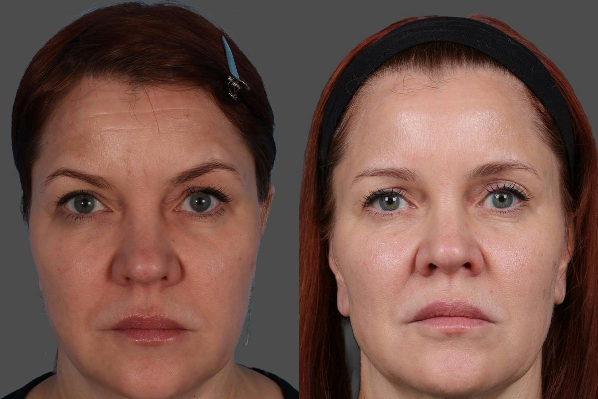 Sculptra® Before & After Gallery - Patient 222350 - Image 1