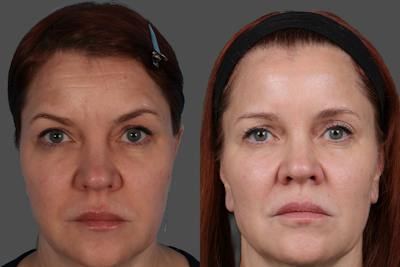 Sculptra® Before & After Gallery - Patient 222350 - Image 1