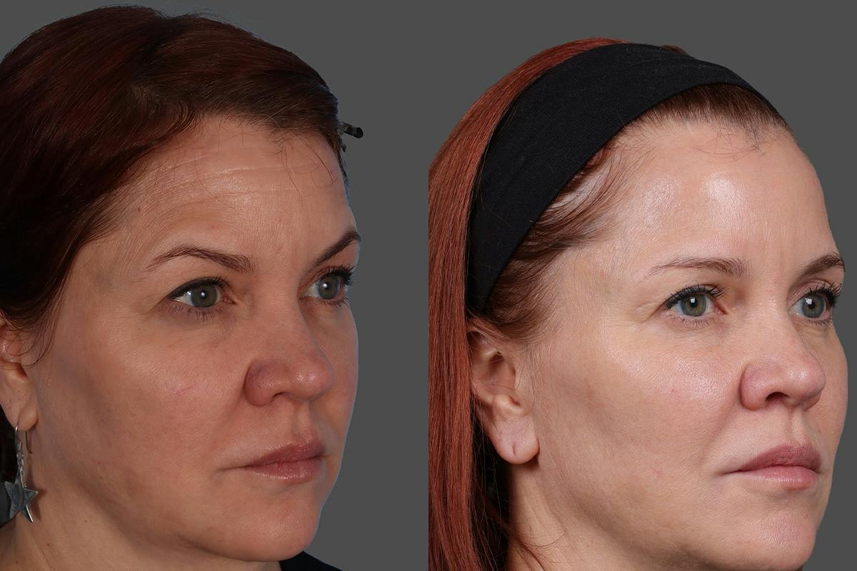 Sculptra® Before & After Gallery - Patient 222350 - Image 2