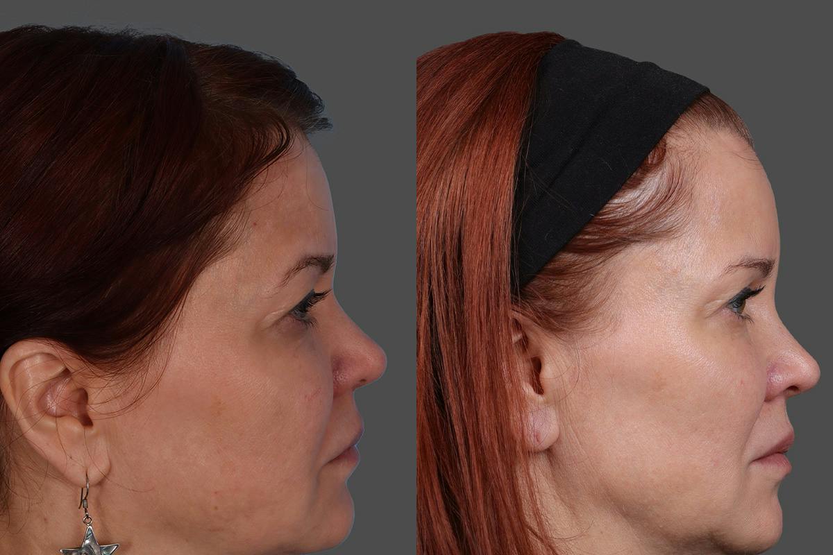 Sculptra® Before & After Gallery - Patient 222350 - Image 3