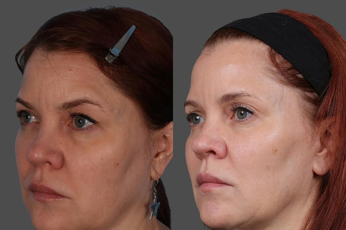 Sculptra® Before & After Gallery - Patient 222350 - Image 5