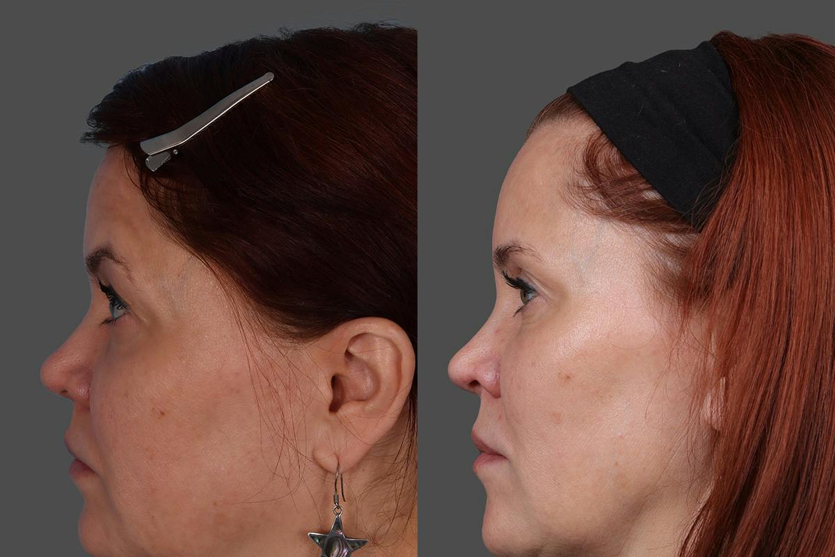 Sculptra® Before & After Gallery - Patient 222350 - Image 4