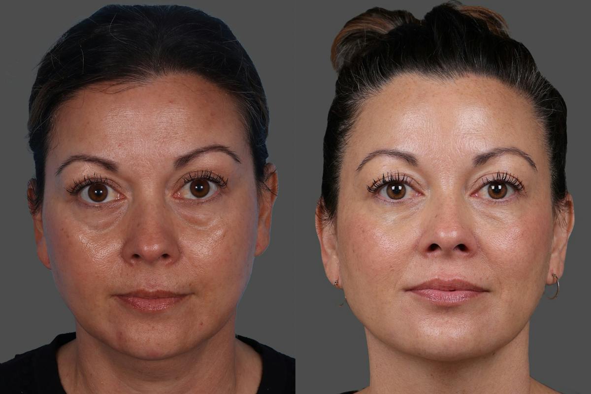 Revance RHA® Before & After Gallery - Patient 318845 - Image 1