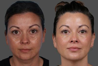 Revance RHA® Before & After Gallery - Patient 318845 - Image 1