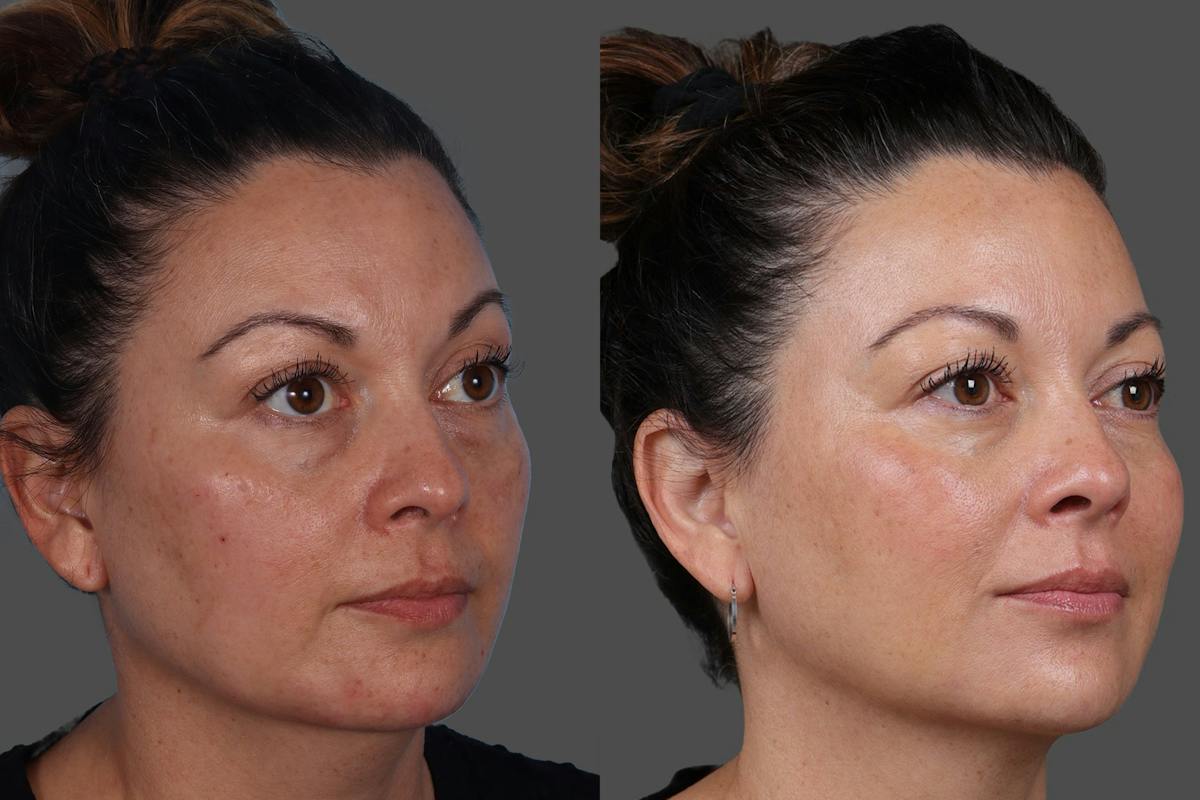 Revance RHA® Before & After Gallery - Patient 318845 - Image 2