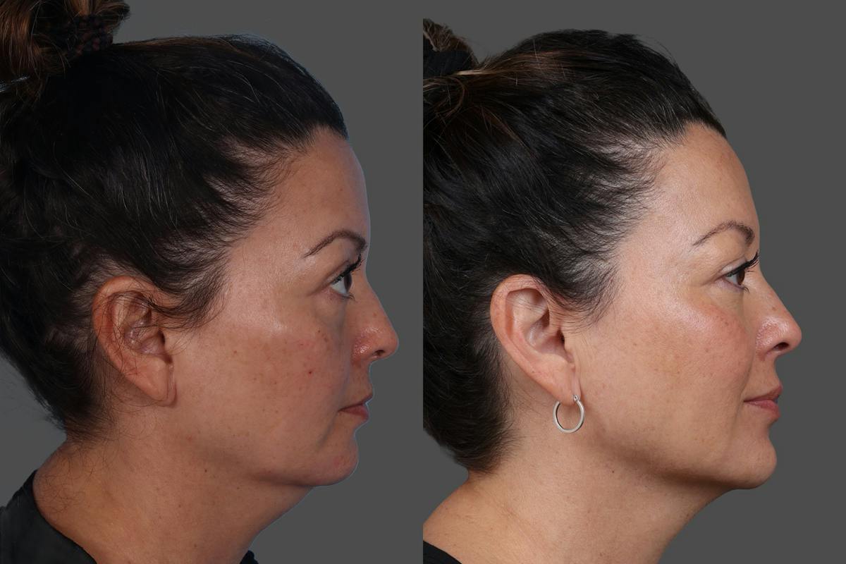 Revance RHA® Before & After Gallery - Patient 318845 - Image 3