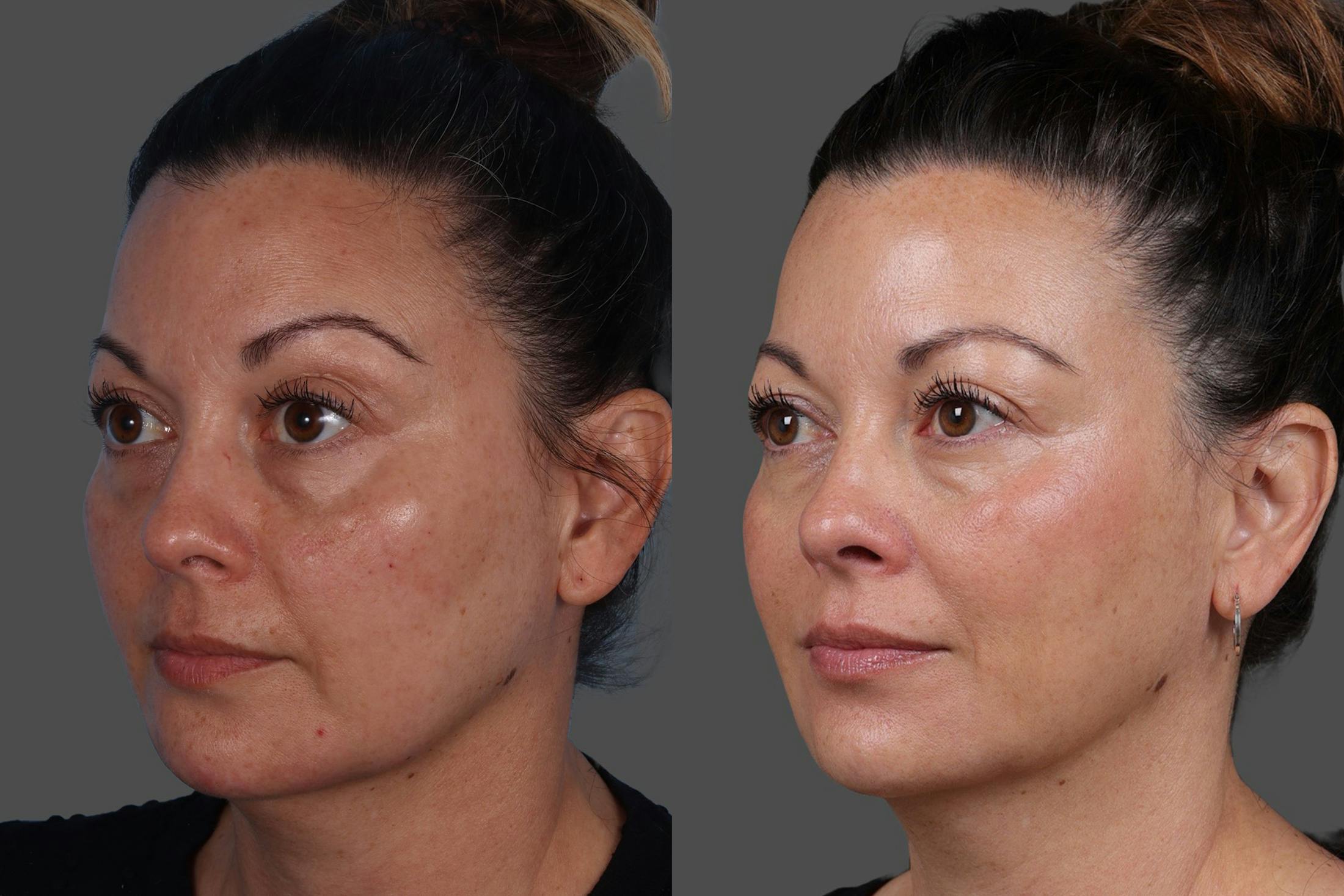 Revance RHA® Before & After Gallery - Patient 318845 - Image 4