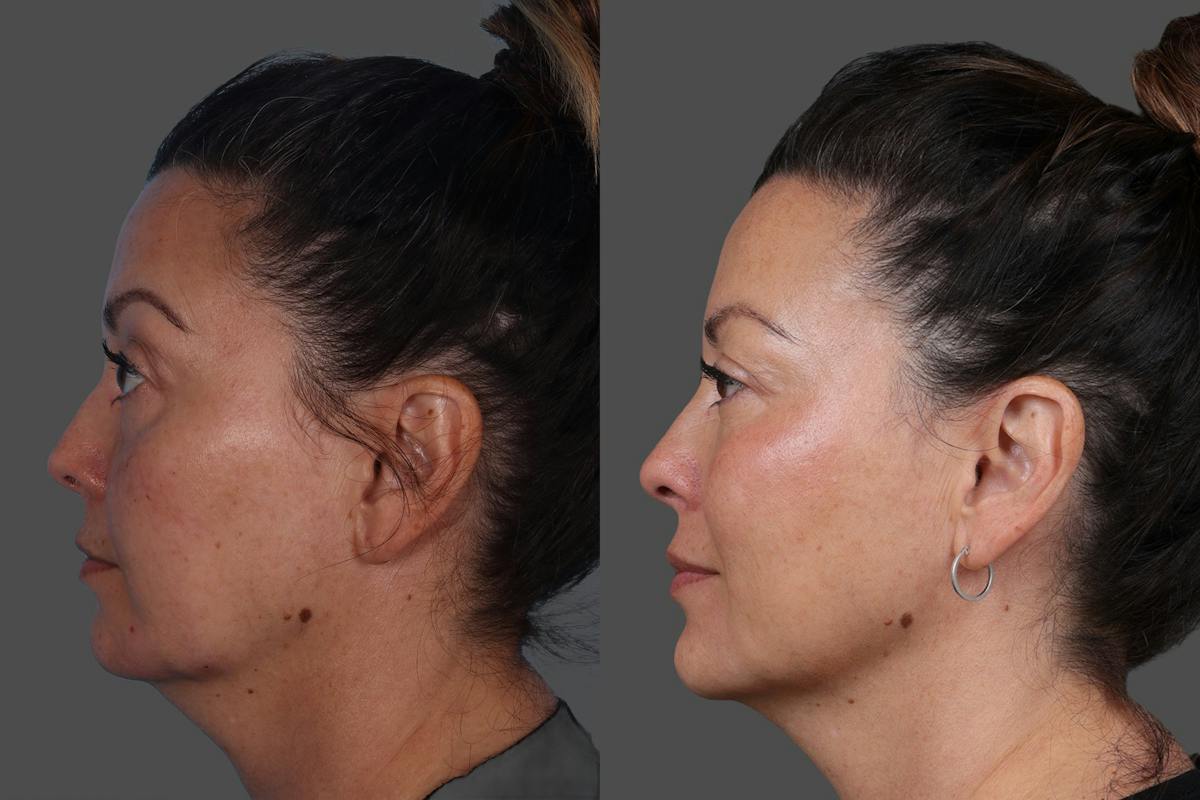 Revance RHA® Before & After Gallery - Patient 318845 - Image 5