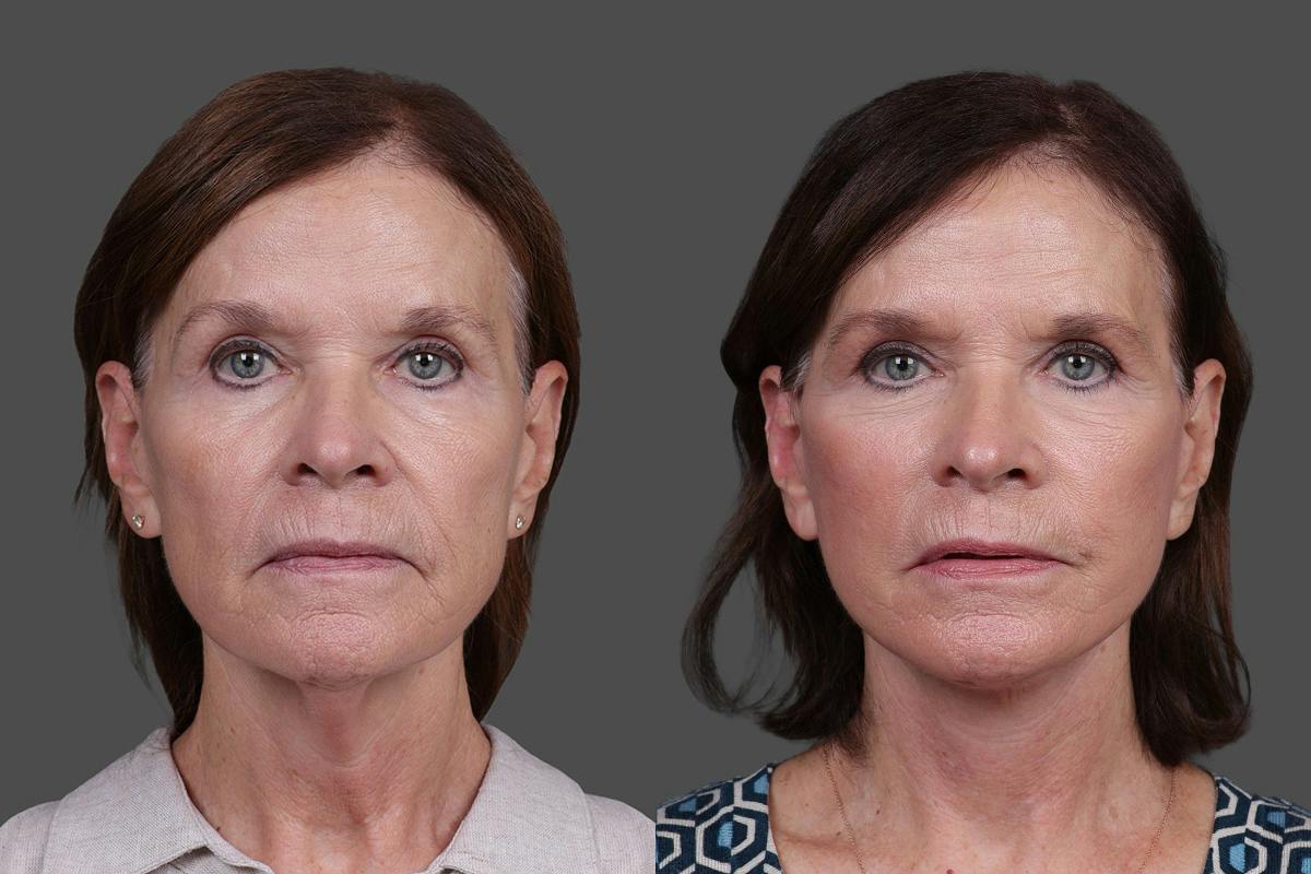 Facelift Before & After Gallery - Patient 412912 - Image 1
