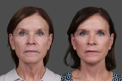 Facelift Before & After Gallery - Patient 412912 - Image 1