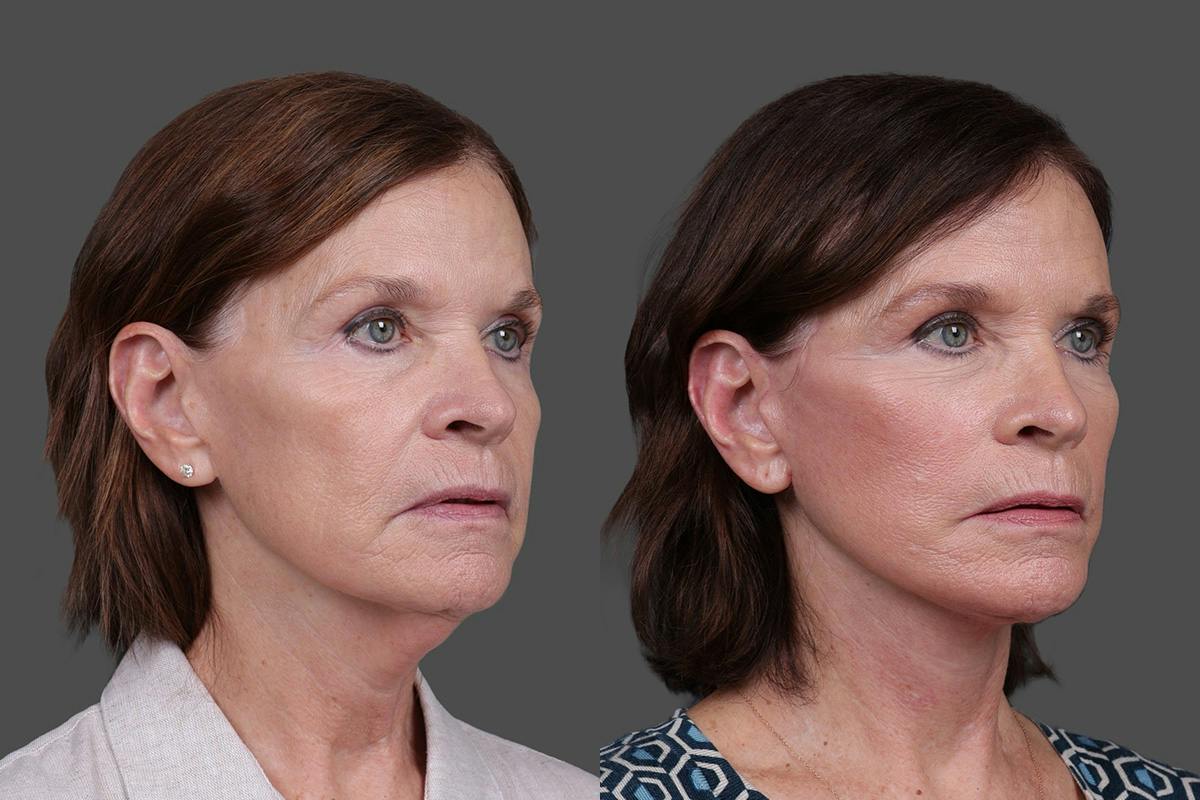 Facelift Before & After Gallery - Patient 412912 - Image 2