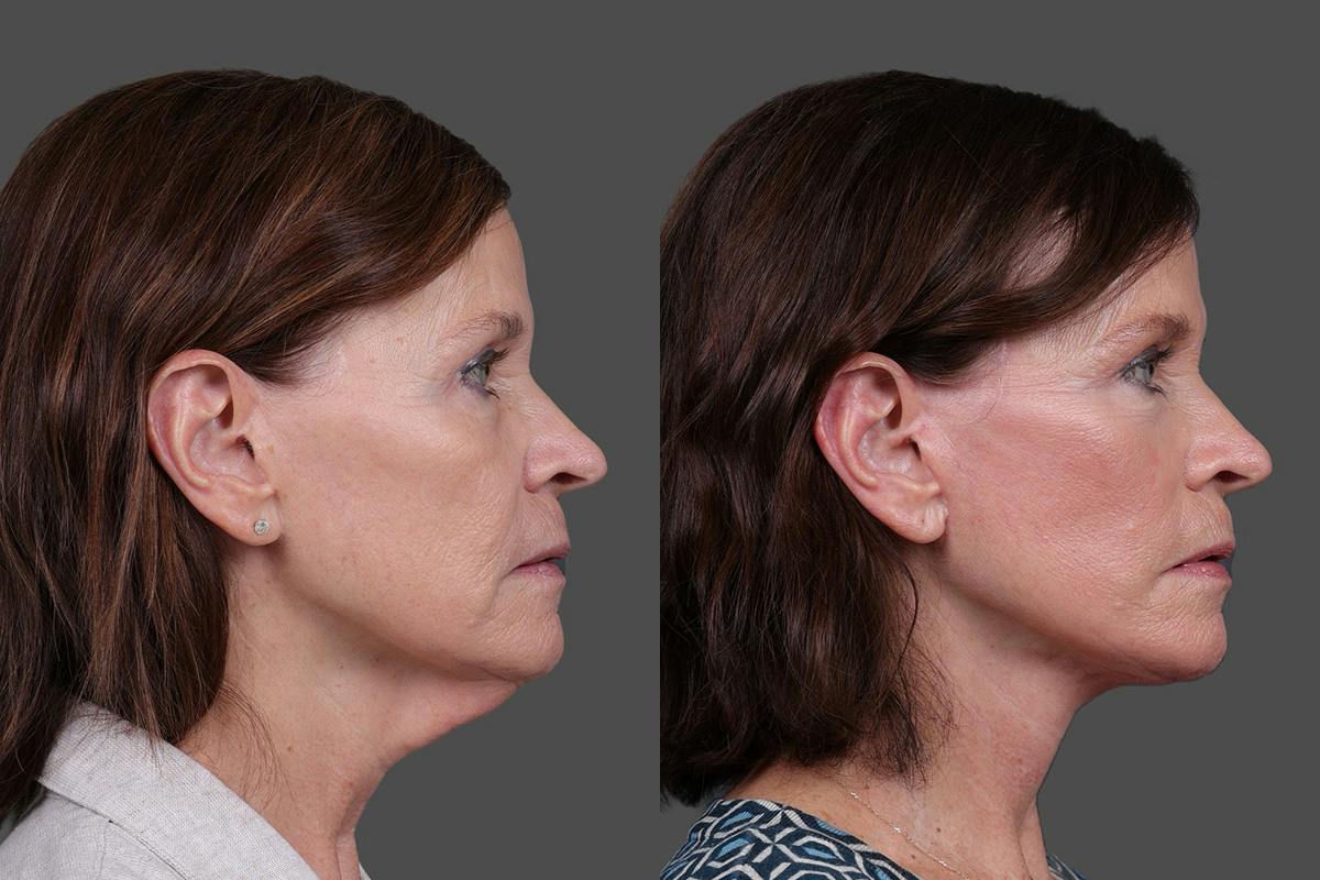 Facelift Before & After Gallery - Patient 412912 - Image 3