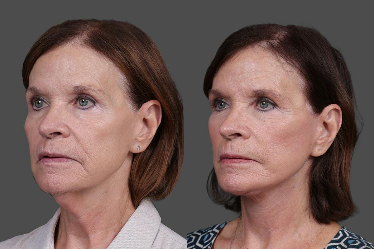 Facelift Before & After Gallery - Patient 412912 - Image 4