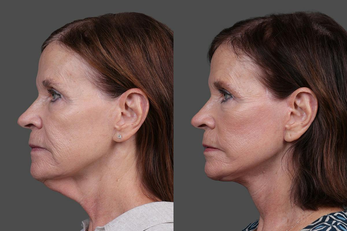 Facelift Before & After Gallery - Patient 412912 - Image 5