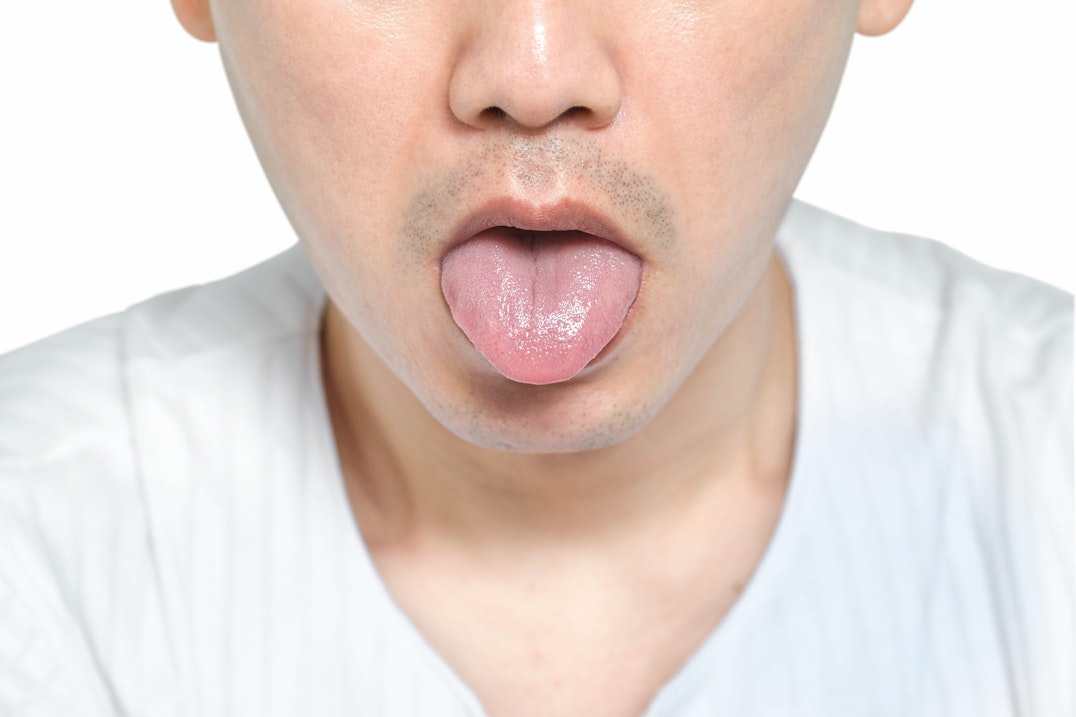 young man tongue burn