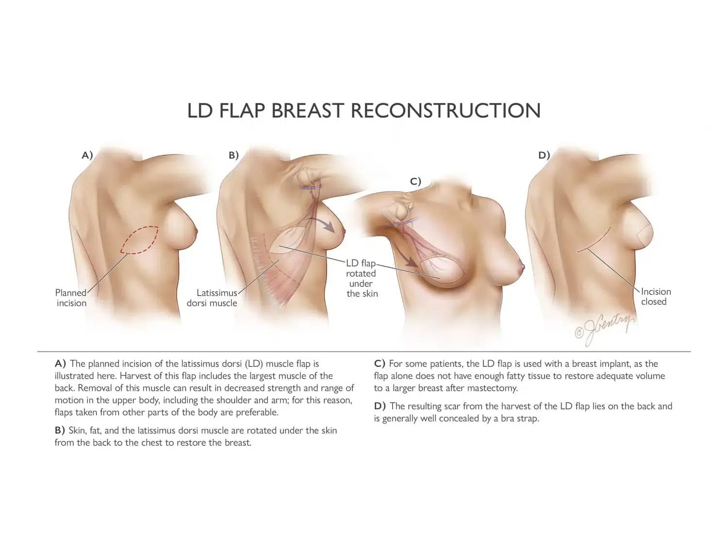 LD flap reconstruction infographic