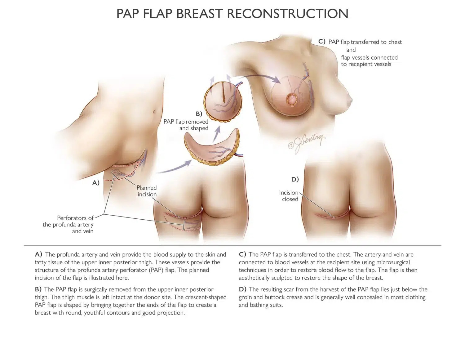 PAP flap infographic