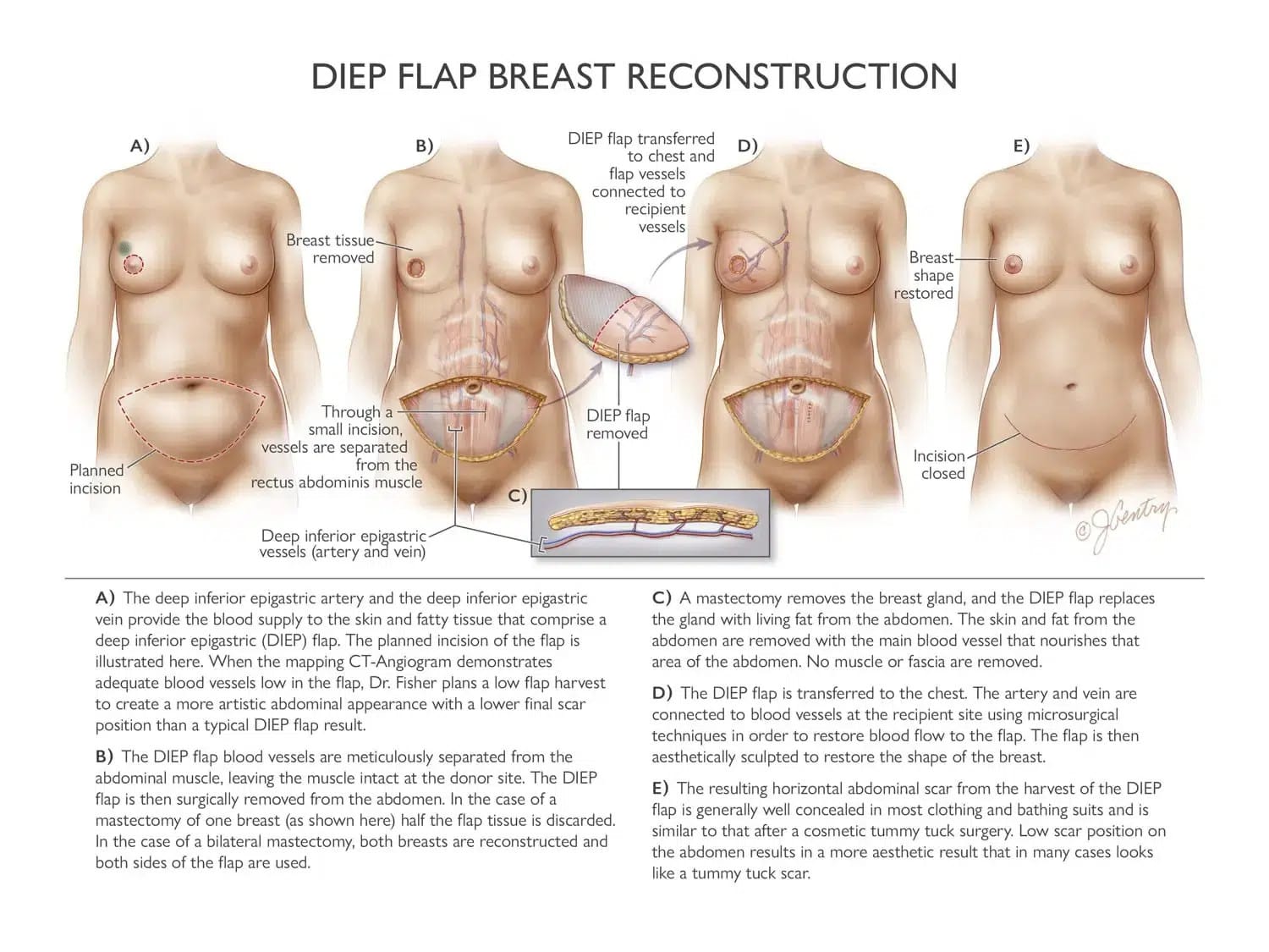 diep flap infographic