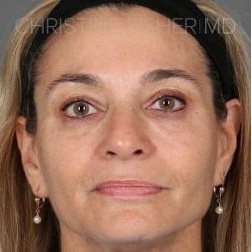 After procedure image for Botox® & Dysport®