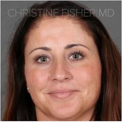Botox® & Dysport® Before & After Gallery - Patient 144580 - Image 1