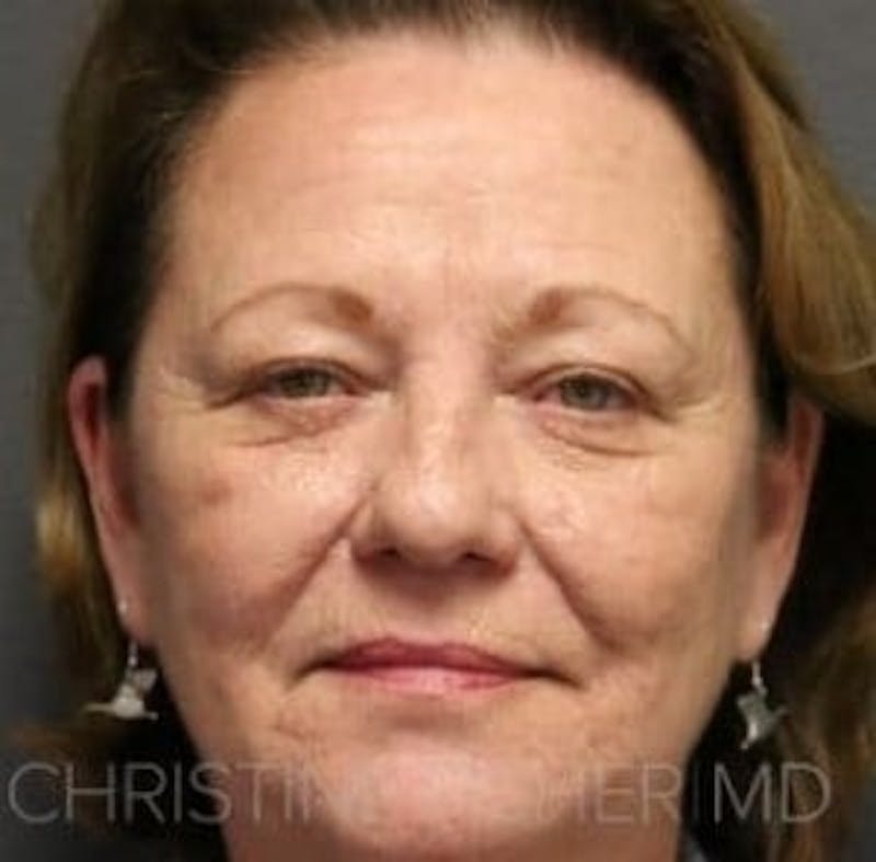 Botox® & Dysport® Before & After Gallery - Patient 165789 - Image 1