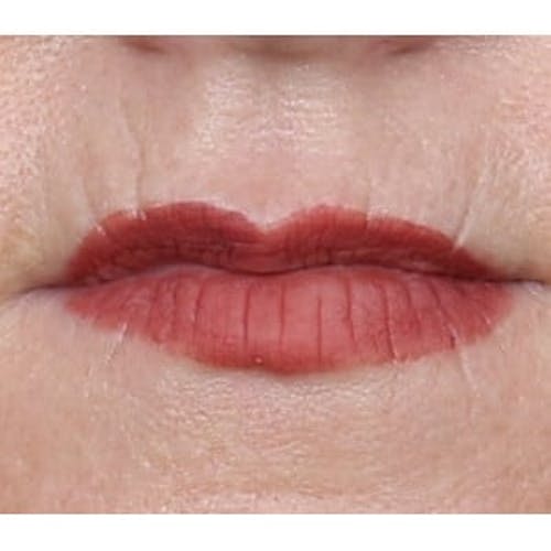 Before procedure image for Collagen & Dermal Fillers