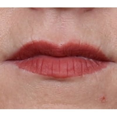 Collagen & Dermal Fillers Before & After Gallery - Patient 432902 - Image 2