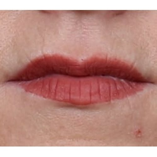 After procedure image for Collagen & Dermal Fillers