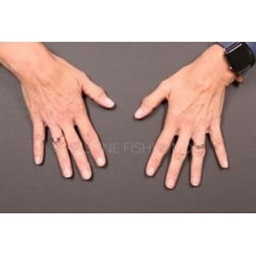 Before procedure image for Collagen & Dermal Fillers