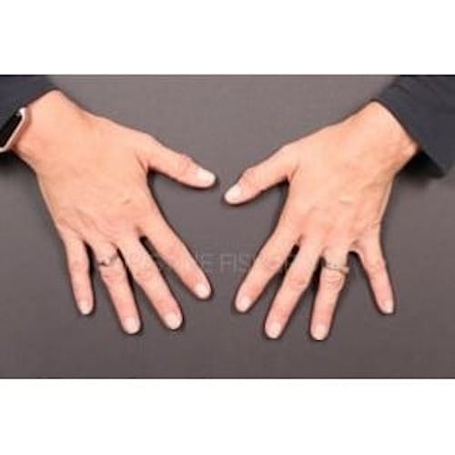 After procedure image for Collagen & Dermal Fillers