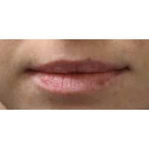 Before procedure image for Collagen & Dermal Fillers