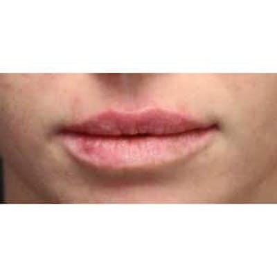 Collagen & Dermal Fillers Before & After Gallery - Patient 302774 - Image 2