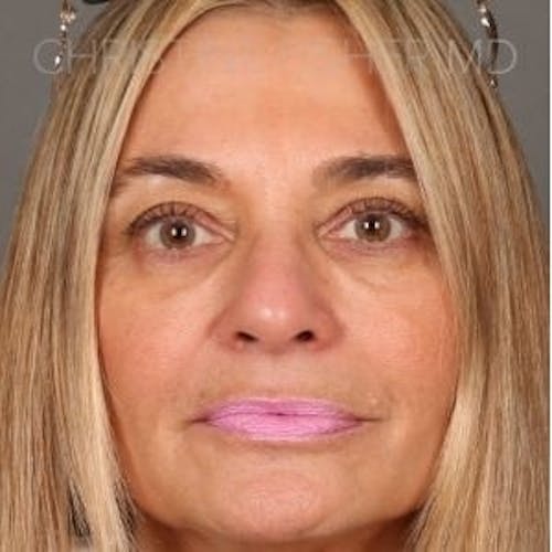 Before procedure image for Liquid Facelift