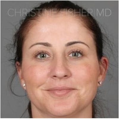 Collagen & Dermal Fillers Before & After Gallery - Patient 337147 - Image 2