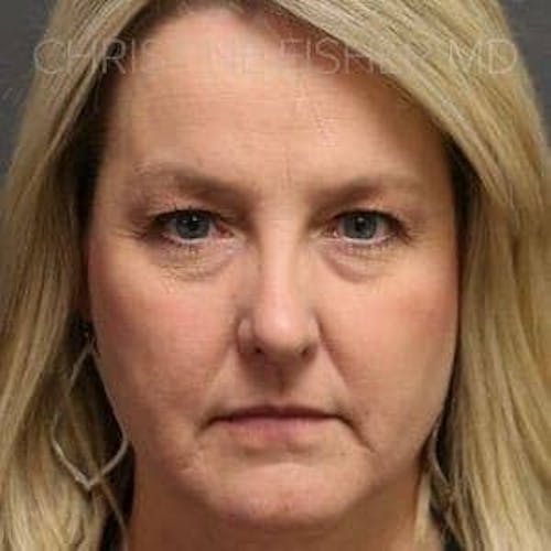 Before procedure image for Liquid Facelift