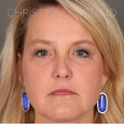 Liquid Facelift Before & After Gallery - Patient 422549 - Image 2