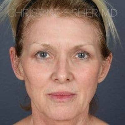 Collagen & Dermal Fillers Before & After Gallery - Patient 314467 - Image 2