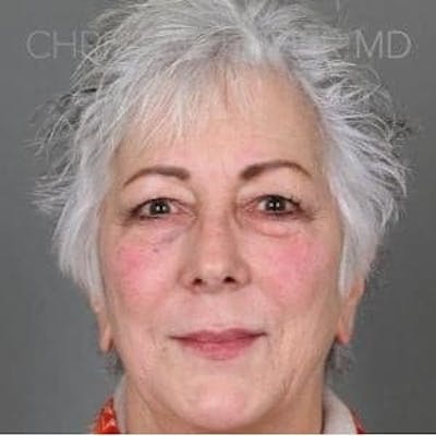 Liquid Facelift Before & After Gallery - Patient 150331 - Image 1
