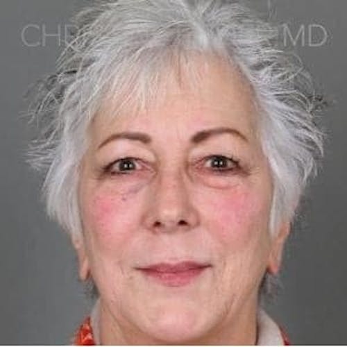 Before procedure image for Liquid Facelift