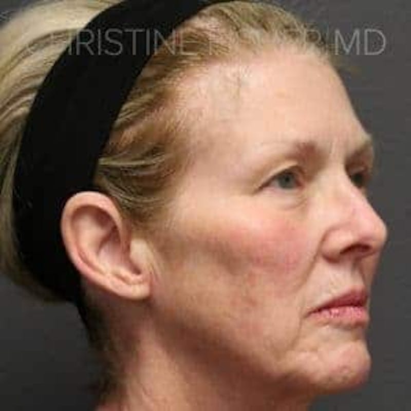 Collagen & Dermal Fillers Before & After Gallery - Patient 314467 - Image 3