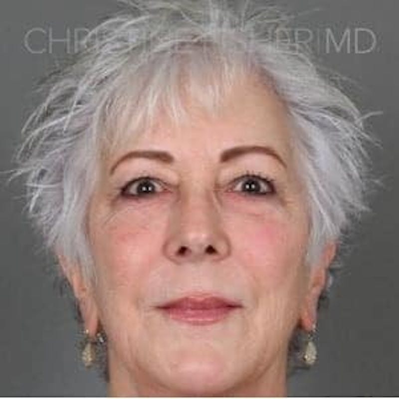 Liquid Facelift Before & After Gallery - Patient 150331 - Image 2