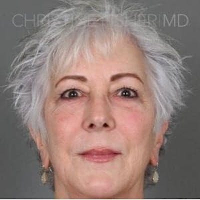 Liquid Facelift Before & After Gallery - Patient 150331 - Image 2