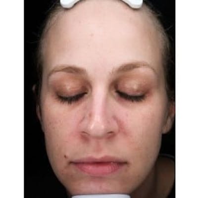 Microneedling Before & After Gallery - Patient 181790 - Image 1