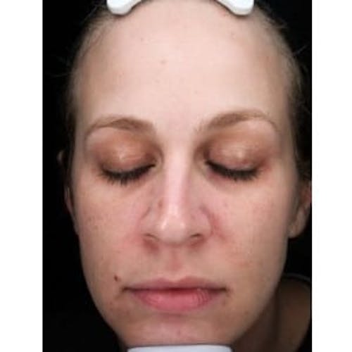 Before procedure image for Microneedling